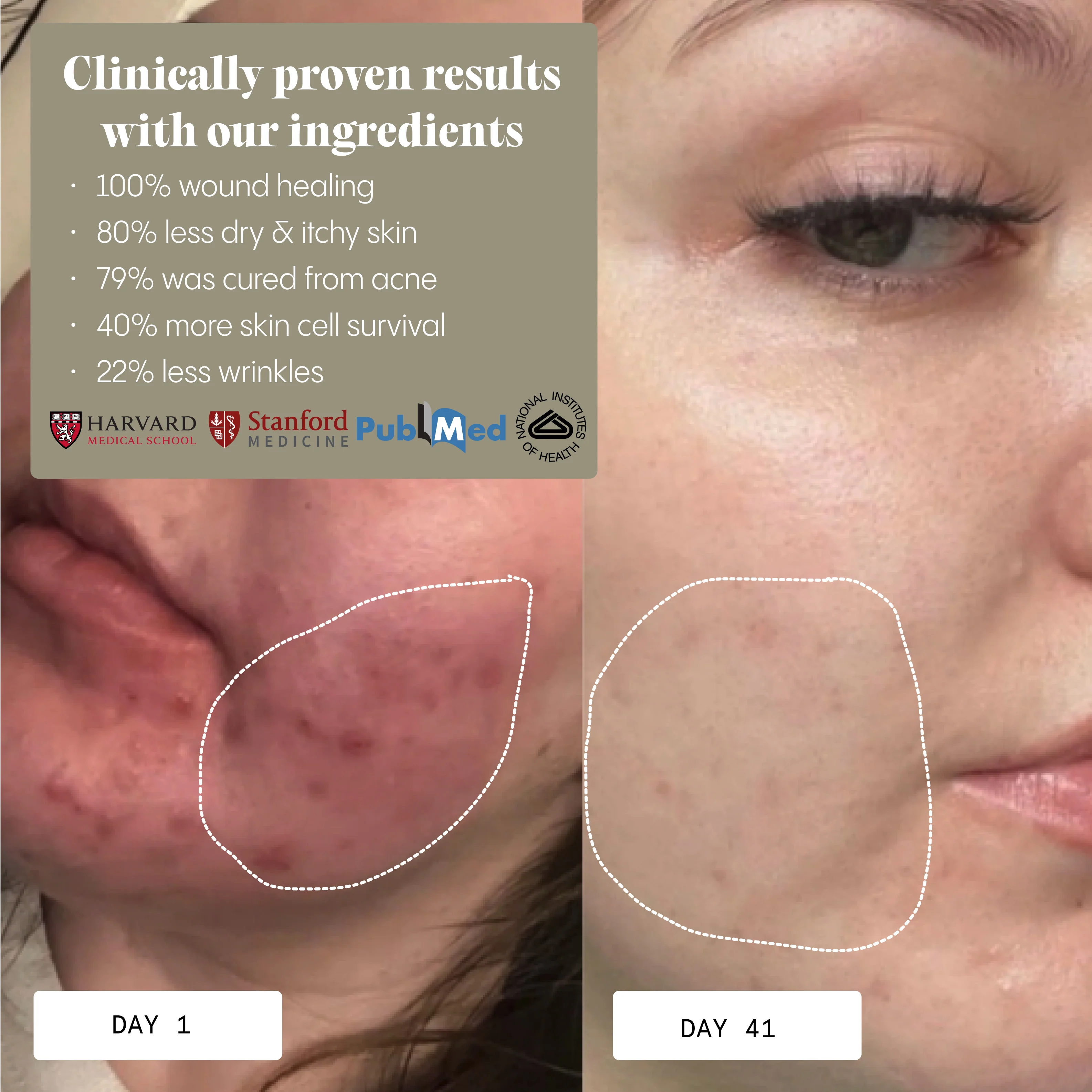 Instant Rosacea, Acne & Redness Stopper - Image 12